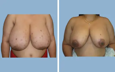 Before and After
